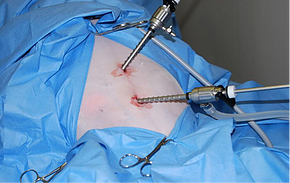 Laparoscopic Ovariectomy: A Less Painful Alternative